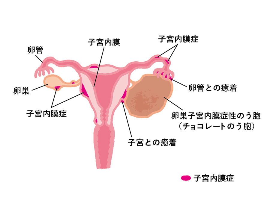 子宮内膜症の症状を和らげる方法